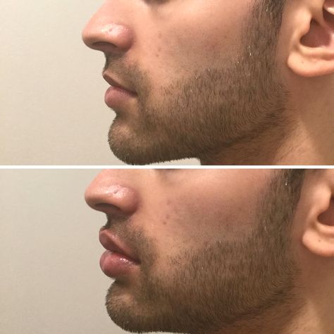 Men Lip Fillers, Mens Lip Filler, Male Lips, Lip Flip, Lips Inspiration, Botox Lips, Boy Post, Facial Surgery, Facial Fillers