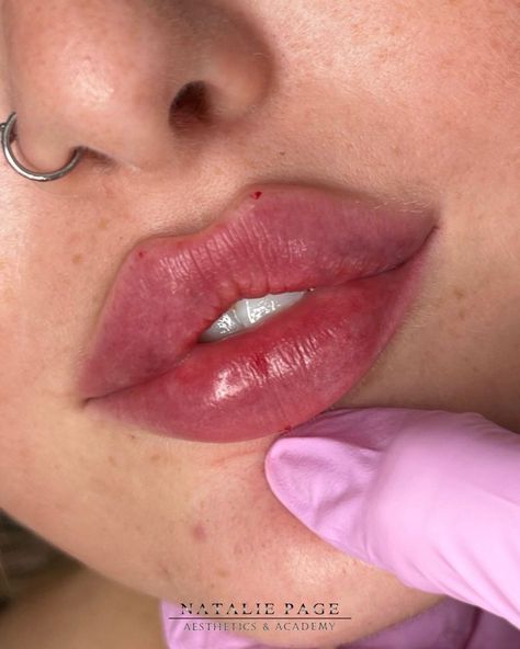 Lip Inspo Filler, Round Lips Filler, Pouty Lip Filler, Russian Lips Filler, Lip Filler Shape Ideas, Desired Lips, Lip Filler Inspiration, Lip Fillers Juvederm, Dream Lips