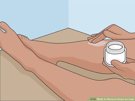 Scar Fading Remedies, Scar Removal Remedies Leg, How To Get Rid Of Scars On Legs Diy, How To Get Rid Of Scars On Legs Fast, How To Remove Scars On Legs Fast, How To Remove Scars, Leg Scars, Removing Hyperpigmentation, Dark Spots On Legs