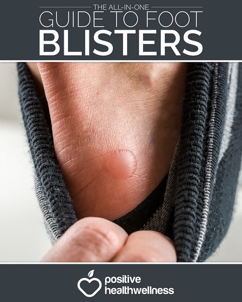 The All-In-One Guide To Foot Blisters - Positive Health Wellness How To Get Rid Of Blisters On Feet Fast, How To Heal Blisters On Feet Fast, Blisters Remedies, Essential Oils For Blisters, How To Treat Blisters, Heal Blisters, Blister Remedies, Water Blister, How To Heal Blisters