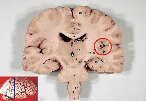 Figure showing the insular cortex (circled) in a coronal section indicated by the blue line in the inset, Modified from Original Image by John Beal PhD, Dep’t. of Cellular Biology & Anatomy, Louisiana State University Health Sciences Center Shreveport, CC-BY Brain Atrophy, Ventral Tegmental Area, Basal Ganglia, Brain Structure, White Matter, Brain Anatomy, Brain Stem, Medical Anatomy, Central Nervous System