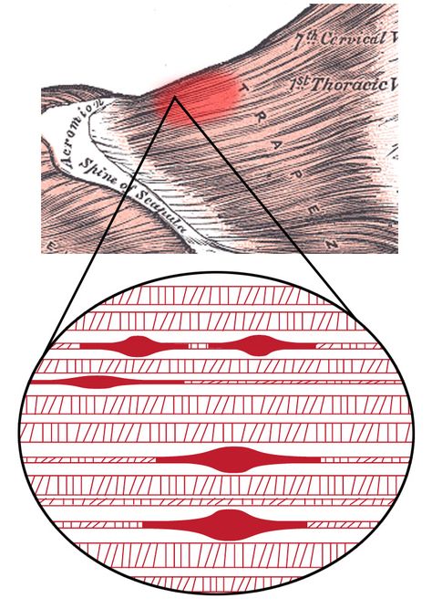 Myofascial Pain Syndrome, Referred Pain, Trigger Point Massage, Muscle Knots, Dry Needling, Trigger Point Therapy, Trigger Point, Myofascial Release, Hand Massage