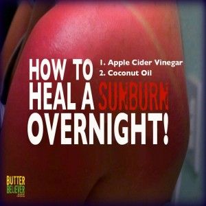 "How to heal a sunburn overnight" Sunburn Peeling, Heal Sunburn, Sunburn Remedies, Sunburn Relief, Peeling Skin, Diy Health, Natural Home Remedies, Cider Vinegar, Apple Cider Vinegar