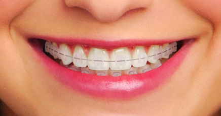 Everything you ever wanted to know about straightening teeth. – The Dental Sherpa #dental #orthodontics #texas https://dentalsherpa.com/2016/02/16/teeth-braces-invisalign-and-the-secrets-of-the-universe/ Gigi Aesthetic, Different Types Of Braces, Behel Gigi, Invisible Teeth Braces, Kawat Gigi, Natural Teeth Whitening Diy, Ceramic Braces, Braces Cost, Types Of Braces