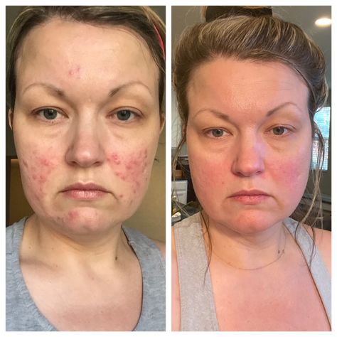 what helped to calm my rosacea | TammyLee Marlene Calming Skincare, Copaiba Essential Oil For Face, Rhoeo Spathacea, Rosewater Benefits Skin, Marula Oil Benefits Skincare, Roscea Help, Dry Skin Care Routine, Winter Skin Care, Dry Skin Care