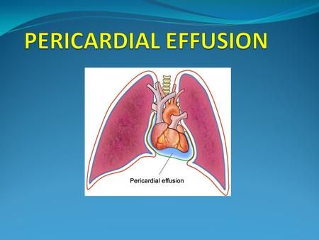 Cardiac Tamponade, Heart Catheterization, Pericardial Effusion, Pleural Effusion, Mitral Valve, Mechanical Ventilation, Atrial Fibrillation