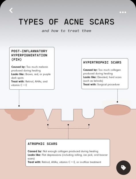 Ice Pick Scars, Hypertrophic Scars, Post Inflammatory Hyperpigmentation, Ice Pick, Types Of Acne, Diy Beauty Hacks, Retinol, Diy Beauty, Dark Spots