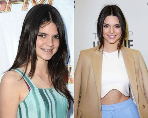 12 Celebs With Braces That Prove It Gets Better Kendall Jenner Braces, Niall Horan Braces, Celebrities With Braces, Kendall Jenner Boyfriend, Beauty Manifestation, Celebrity Interview Questions, Amelia Gray Hamlin, Invisible Braces, Brace Face