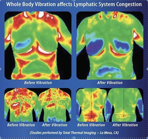 HOW DOES WHOLE BODY VIBRATION MOVE LYMPHATIC FLUID? Scientists have found that full body vibration can help both lymphatic and oxygen circulation. The high frequency vibrations of Lifetimevibe circulate lymph and boost the immune system. https://lifetimevibe.com/2022/01/14/lymphatic-system-and-whole-body-vibration/ Vibration Machine Benefits, Heart Pumping Blood, Plate Exercises, Lymph Drainage Massage, Vibration Plate Exercises, Drainage Massage, Whole Body Vibration, Power Plate, Vibration Plate