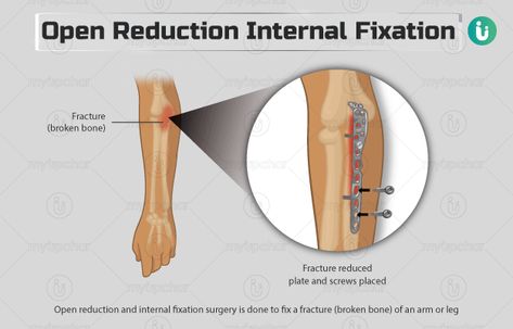 Discover the ins and outs of ORIF (Open Reduction Internal Fixation) surgery for bone fractures and injuries. Get informed about ORIF here. - #Bonerepairprocedure #Bonestabilizationprocedure #Fracturefixationsurgery #Fracturerepairsurgery #Internalfixationsurgery #OpenReductionInternalFixation #Opensurgeryforfractures #ORIFprocedure #ORIFsurgeryforbrokenbones #Orthopedicsurgeryforfractures #Orthopedicsurgicaltechnique #Surgicaltreatmentforbrokenbones Types Of Fractures, Vein Thrombosis, Bone Fracture, Lower Extremity, Med Surg, Hand Therapy, Surgery Recovery, Wound Care, After Surgery