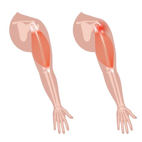 Biceps Muscle, Muscle Arm, Bicep Muscle, Muscle Cramps, Premium Vector, Graphic Resources, Human Body, Human