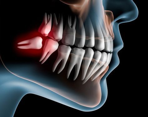 A diagram of a Impacted wisdom teeth Impacted Wisdom Teeth, Teeth Surgery, Impacted Tooth, Cracked Tooth, Wisdom Tooth Extraction, Remedies For Tooth Ache, Bone Grafting, Dental Photography, Wisdom Teeth Removal