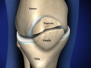 Treating Patella Fracture (Broken Knee Cap) in Plano, Frisco, McKinney and Allen Broken Knee Cap, Patella Fracture, Broken Knee, Baby Bump Photoshoot, Knee Cap, Knee Surgery, Knee Replacement, Knee Brace, Knee Injury