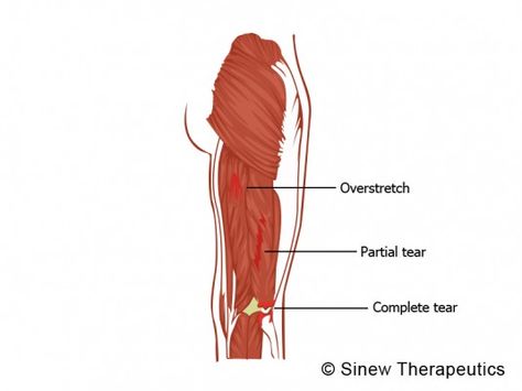 Hamstring Pulled Torn Information - Sinew Therapeutics Hamstring Rehab, Torn Hamstring, Health