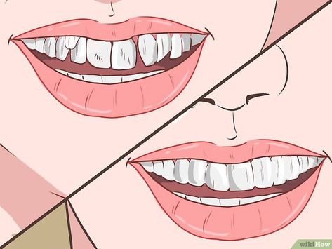 How to Straighten Your Teeth Without Braces (with Pictures) Straight Teeth Without Braces, Straighten Teeth Without Braces, Diy Braces, Teeth Correction, Fix Teeth, Teeth Aesthetic, Teeth Remedies, Teeth Whitening Procedure, Dental Health Care