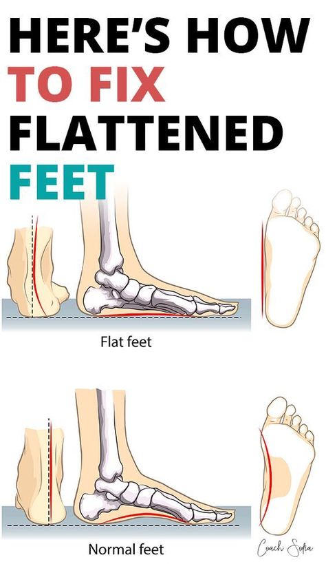 Flat Feet Exercises For Kids, Flat Feet Remedies, Flat Feet Exercises, Vitamins For Nerves, Exercise Coach, Fallen Arches, Foot Exercises, Flat Foot, Nerve Pain Relief