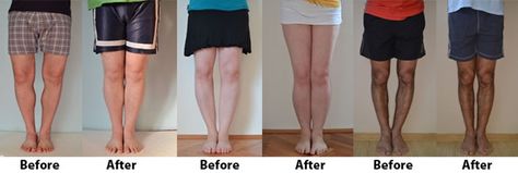 Bow Legs - How to Straighten Your Legs Without Surgery Genu Varum, Bow Legged Correction, Knock Knees, Muscle Atrophy, Bow Legged, Perfect Legs, Kinds Of Clothes, Easy Workouts, Fix It