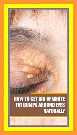 How To Get Rid of White Fat Bumps Around Eyes Naturally White Bump On Eyelid, Essential Oils For Pregnancy, Lower Back Pain Exercises, Natural Hair Mask, Sciatic Nerve Pain, Skin Spots, White Patches, Skin Disorders, White Eyes