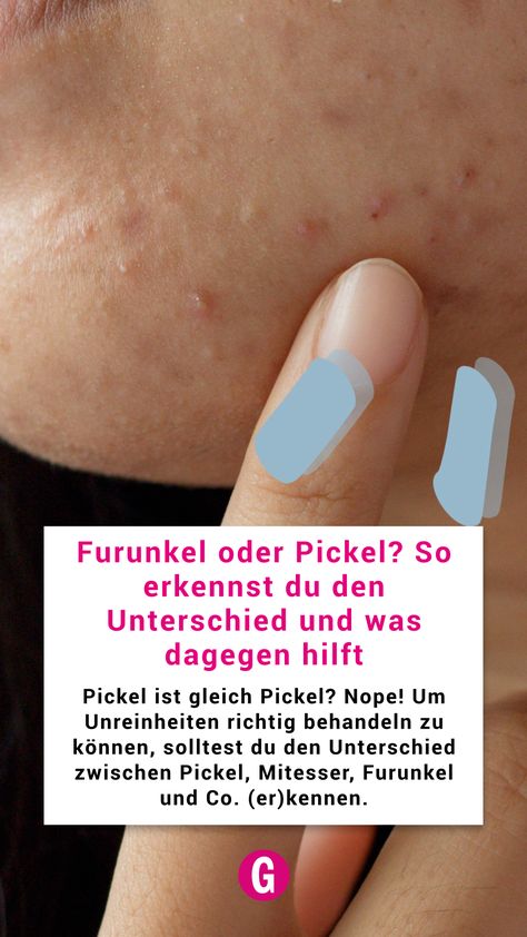 Pickel ist gleich Pickel? Nope! Um Unreinheiten richtig behandeln zu können, solltest du den Unterschied zwischen Pickel, Mitesser, Furunkel und Co. (er)kennen. Beauty Education, Health Skin Care, Blackheads, Skin Health, Beauty Hacks, Education, Skin, Health, Pins