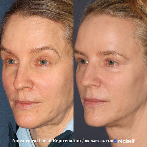 Sculptra Before And After Faces, Sculptra Before And After, Cheek Fillers Before And After Face, Facial Balancing Filler, Sculptra Filler, Mid Face Lift, Nose Fillers, Liquid Facelift, Chin Filler