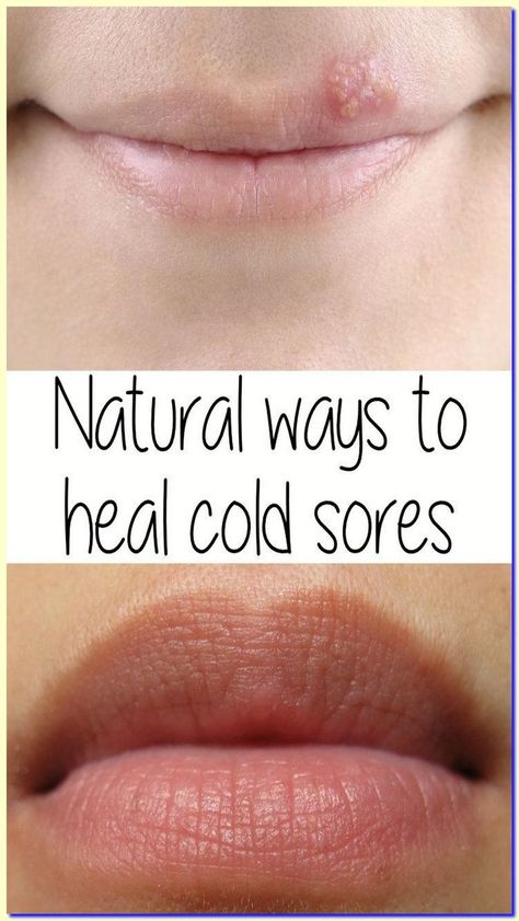 WHAT SHE SPREADS ON HER SKIN, EVERYONE HAS AT HOME, BUT NOBODY USES IT! Cold Sore Remedy, Common Cold Remedies, Natural Cold Sore Remedy, Cold Allergy, Stye Remedies, Eye Stye Remedies, Get Rid Of Cold, Ways To Heal, Healthy Facts