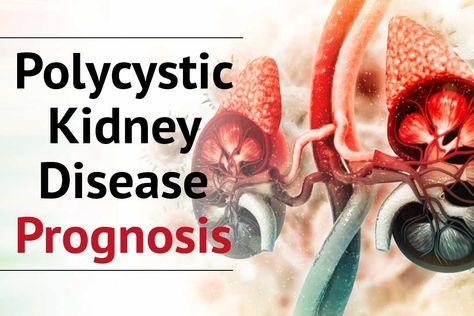 Finding the right polycystic kidney disease prognosis without kidney transplant? If yes, then come to Karma Ayurveda today. Mary Phillips, Improve Kidney Function, Polycystic Kidneys, Kidney Damage, Memory Problems, Kidney Health, Diet Nutrition, Organic Health, Signs And Symptoms