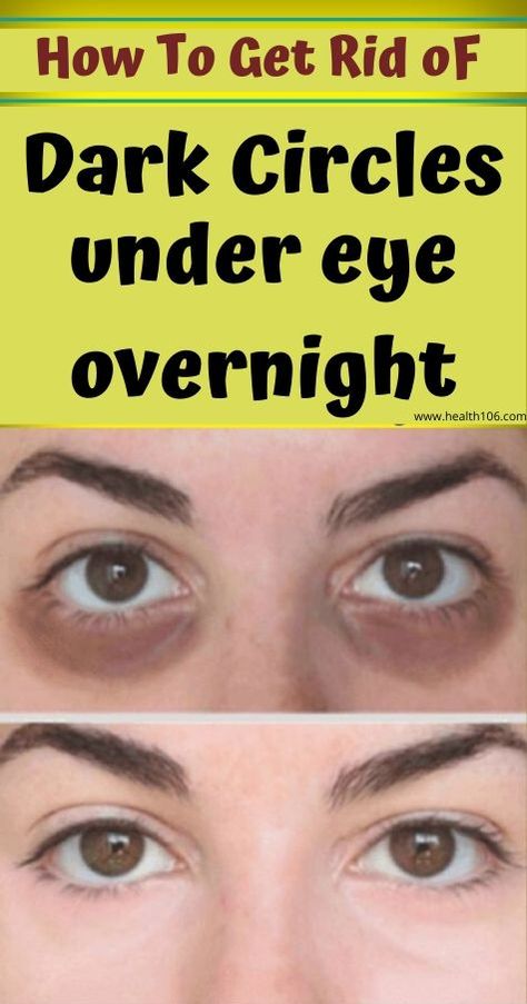 How to get rid of dark circles under eyes overnight. Two girls getting rid of eye bags and under eye circles ... For every late night chatting over drinks, for every day out in the sun and for every bed Dark Rings Under Eyes, Eye Circle Remedies, Dark Circle Remedies, Wrinkle Remedies, Dark Circles Treatment, Dark Eye Circles, Beauty Hacks Skincare, Makeup Tip, Under Eye Wrinkles