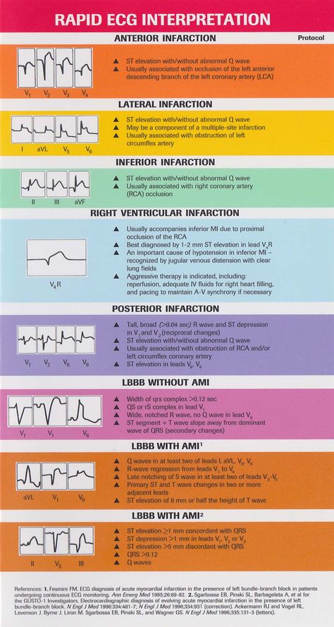 Ems Cheat Sheets, 12 Lead Ekg Interpretation Cheat Sheets, St Elevation Ekg, Cardiac Drips Cheat Sheets, Critical Care Nursing Cheat Sheets, Ekg Notes, Cardiac Pathology, Telemetry Technician, Medic School