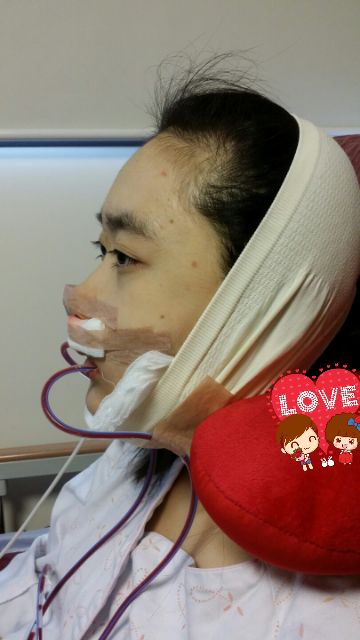 Check out this blog to see her before and after surgery experience diary at ID Hospital! She underwent double jaw surgery and facial contouring to achieve a more feminine facial contour. Isn't she so cute now? Amazing! Thanks to ID Hospital! #plasticsurgery #doublejawsurgery #double #jaw #surgery #jawsurgery #orthognathic #orthognathicsurgery #underbite #rhinoplasty #nose #lips #teeth #mouth #facial #bone #facialcontouring #contouring #highlighting #aging #braces #korea #seoul #gangnam Underbite Before And After, Jaw Surgery Before And After, Jaw Surgery Before And After Underbite, Periareolar Top Surgery, Jaw Surgery Before And After Overbite, Seoul Gangnam, Double Jaw Surgery, Orthognathic Surgery, Corrective Jaw Surgery