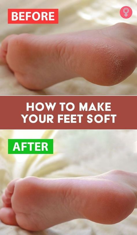 Soften Feet Overnight, Soft Feet Remedy, Cracked Feet Remedies, Dry Feet Remedies, Soften Heels, Cracked Heel Remedies, Diy Foot Soak, Dry Cracked Heels, Dry Heels