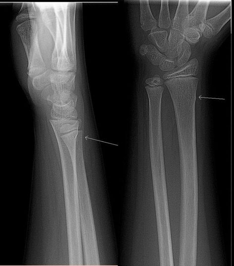 distal radius torus fracture Wrist Fracture, Med Surg, Christian Romance, Medical Dental, Bull Riders, Hockey Player, Compare And Contrast, Radiology, Fast Track