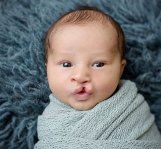 Cleft Palate Speech Therapy, Cleft Lip And Palate, Cleft Palate, Cleft Lip, Oral Motor, Unborn Baby, Parent Child Relationship, Tiny Humans, Breast Milk