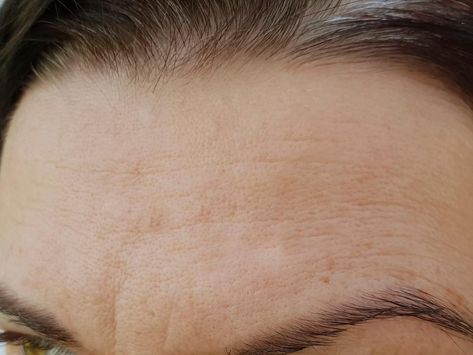 Forehead Wrinkles Remedies, Remove Forehead Wrinkles, Get Rid Of Forehead Wrinkles, Facial Wrinkles, Forehead Wrinkles, Exfoliating Cleanser, Acne Marks, Deep Wrinkles, Chemical Peel