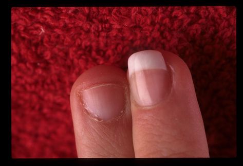 Magical Nail Makeovers - Technique - NAILS Magazine Nails For Small Nail Beds, Small Nail Beds, Ski Jump, Acrylic Ideas, Small Nail, New Nail Designs, Trendy Nail Art Designs, With Nails, Nail Bed