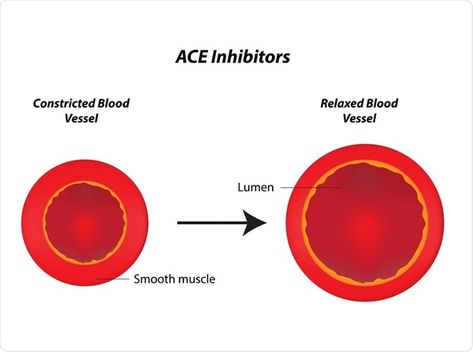 Ace Inhibitors, Hardening Of Arteries, Adrenergic Agonist, Hypertensive Medications, Renin Angiotensin Aldosterone System, Hypertensive Crisis, Kidney Function Test, Low Potassium Diet, Acute Kidney Injury