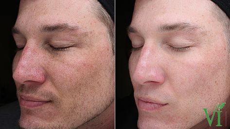 Vi Peel, Facial Plastic, French Decor, Utah, Facial, Skin Care, Skin