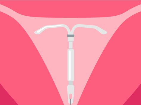 What to Expect After IUD Removal: Ob/Gyn Experts Explain | SELF Mirena Iud Removal, Iud Side Effects, Iud Removal, Mirena Iud, Period Cramps, Period Pain, Family Planning, Visual Aids, What Happened To You