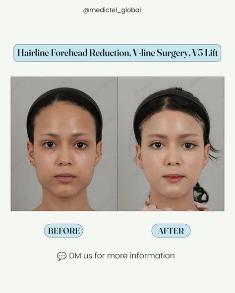 Hairline Forehead Reduction, V-line Surgery, V3 Lift: Here's all you need to know ⬇️ ✅️ Hairline Forehead Reduction: This procedure designs the hairline to bring it forward and decrease the height of the forehead. Transposition ensures a much more balanced proportion with other facial features. ➡️ Benefits: - It enhances facial harmony by creating a more proportionate forehead.  - Reduces the appearance of a high forehead, which is aging. ➡️ Considerations: - As with all surgeries, swel... Forehead Surgery, Forehead Reduction Surgery, Facial Harmony, Forehead Reduction, V Line Surgery, Facial Aesthetic, High Forehead, Skin Advice, V Line