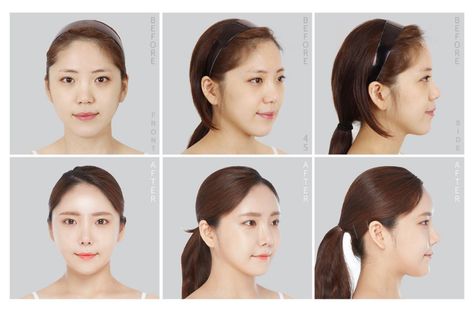 VIEW PLASTIC SURGERY: Yoo Hyun Joo; Square Jaw Reduction + Genioplasty + Cheekbone Reduction | by VIEW PLASTIC SURGERY | Medium Cheekbone Reduction, Square Jaw, Rhinoplasty Nose Jobs, Types Of Facials, Facial Surgery, Fat Grafting, Nasolabial Folds, Face Lines, Nose Job