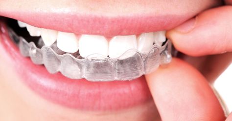 Teeth-straightening startup SmileDirectClub gets $3 billion valuation in new fundraising. Transparent Braces, Invisalign Braces, Family Dental Care, Teeth Alignment, Invisible Braces, Clear Braces, Dental Braces, Teeth Straightening, Clear Aligners