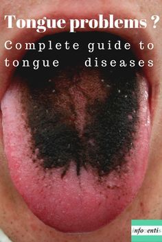 Tongue Sores Causes, Ulcer On Tongue, Tongue Problems, Healthy Tongue, Tongue Sores, Red Tongue, Black Tongue, Nail Problems, Tongue Health