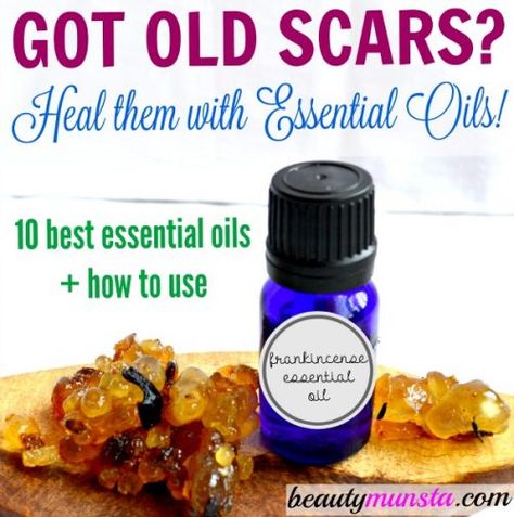 Essential oils for old scars: The cicatrisant or cell/tissue regenerative properties in essential oils aid in healing old and new scars! Find out the best essential oils for old scars in this article! Oils For Scars, Esential Oils, Essential Oil Beauty, Essential Oil Remedy, Oil Remedies, Acne Oil, Sleep Eye, Essential Oils For Skin, Frankincense Essential Oil