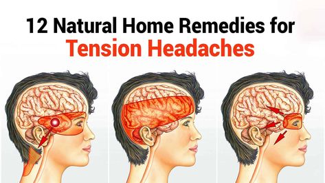 Suffer from tension headaches? Commercial pain relievers don't usually address the underlying cause. Here are time-proven home remedies, instead. Tension Headache Remedies, Peppermint Oil Uses, Tension Headache Relief, Home Remedy For Headache, Frequent Headaches, Natural Headache, Natural Pain Relievers, Migraine Pain, Headache Types