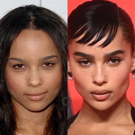 PROBLEMATIC FAME on Instagram: “zoë kravitz then + now edit: zoë deleted the tag ( reminder! my posts are not meant to accuse anyone of having any cosmetic procedures or…” Before After Surgery, Cheek Implants, Chin Augmentation, Plastic Surgery Gone Wrong, Botox Lips, Rhinoplasty Before And After, Zoë Kravitz, Celebrity Plastic Surgery, Celebrities Before And After