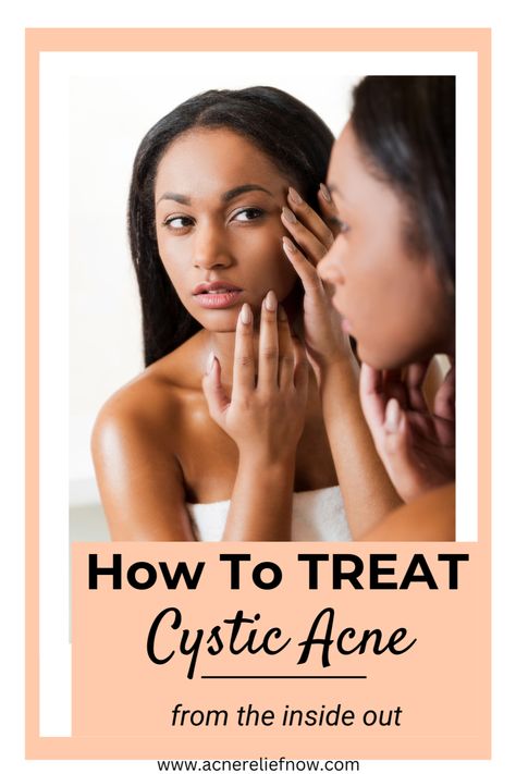 Natural ways to treat hormonal acne. How to manage hormonal acne. Learn what causes hormonal acne, ways to treat hormonal acne at home, hormonal acne tips, hormonal acne diet plan and treating hormonal acne naturally. Click the pin to get rid of hormonal acne for good. Acne Prone Skin Care Products, Skincare Acne Prone Skin, Acne Diet Plan, Skincare Routine Natural, Treatments For Acne, Hormonal Acne Diet, Comedonal Acne, Treating Cystic Acne, Acne Diet