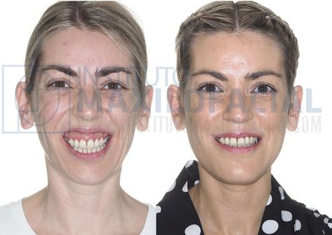 Bimaxillary surgery for the correction of Class II bite and gummy smile. Gummy Smile Correction, Orthognathic Surgery, Facial Surgery, Gummy Smile, Dental Care, Surgery, Facial