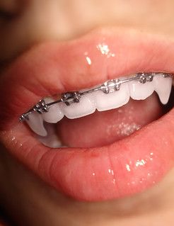 Like a.....vampire... | Rali ♥ | Flickr Braces Drawing, Silver Braces, Lips Aesthetic, Teeth Aesthetic, Teeth Bleaching, Dental Braces, Perfect Teeth, Teeth Braces