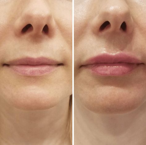 Saggy Cheeks, Face Plastic Surgery, Lip Flip, Plumper Lips, Botox Before And After, Botox Lips, Lip Filler, Lip Enhancement, Botox Fillers