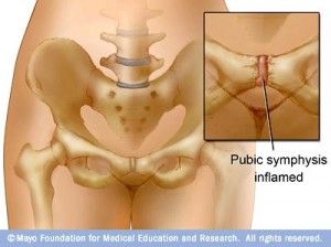 General Pubic Symphysis Dysfunction: The pubic symphysis is a very stiff, synovial joint that exists midline of the pelvis. It moves on average, about 2 mm but becomes dysfunctional if it moves more or less. The cause for pubic symphysis dysfunction can be attributed to hormonal changes, lengthening and weakening of pelvic ligaments, thoracolumbar fascia … Medical Assistant Student, Pelvic Girdle, Pelvic Bone, Mom Bod, Psoas Muscle, Fit Mama, Sciatica Pain, Joints Pain Relief, Pelvic Pain