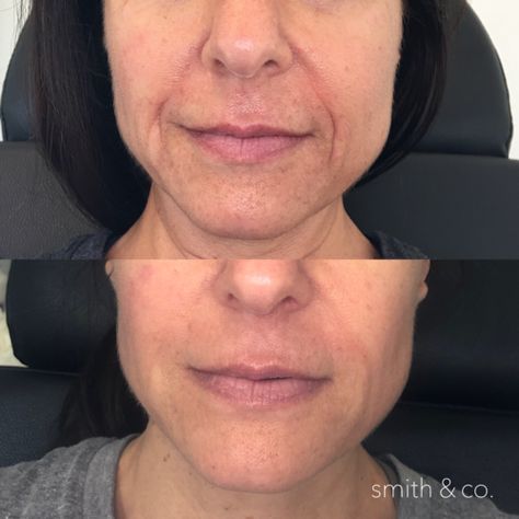 Botox In Smile Lines, Botox For Smile Lines, Botox Smile Lines Before After, Smile Lines Filler Before And After, Smile Line Fillers Before And After, Er Nursing, Botox Before And After, Face Fillers, Danielle Smith